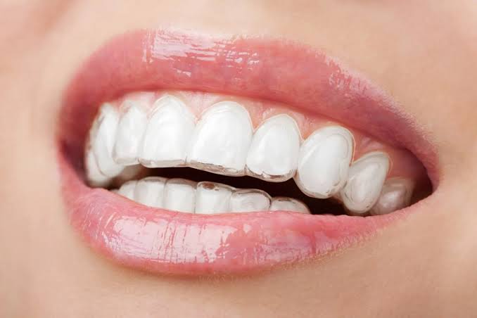الاینر شفاف در برابر براکت سنتی