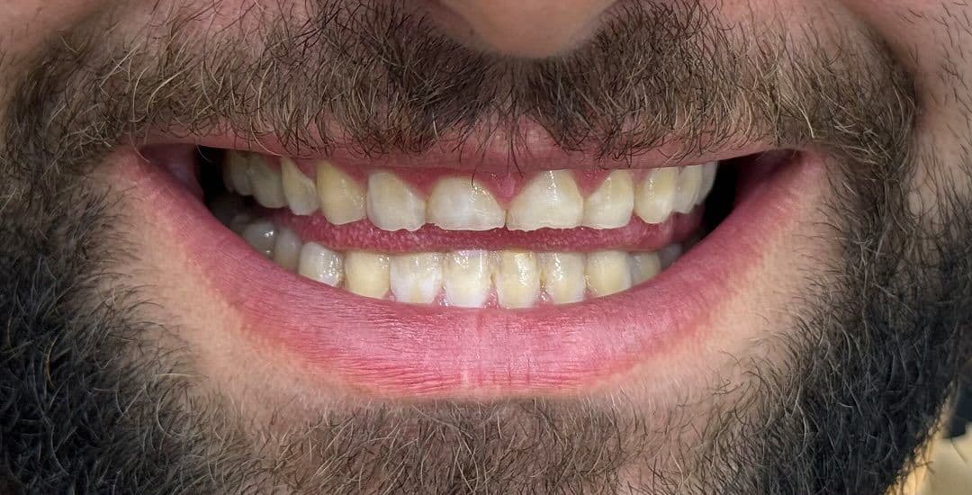 بعد: اصلاح لبخند با لمینت